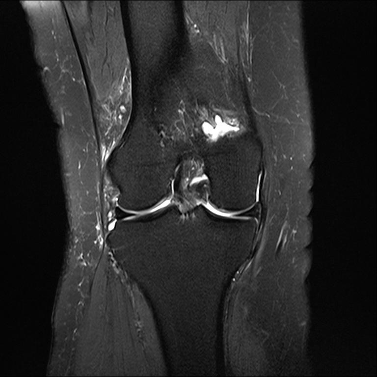 Meniscus Unstable meniscus Definition A tear in which the meniscus or a meniscal fragment is