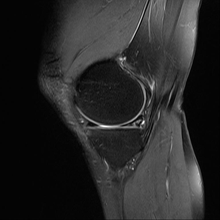 47/M MVA Medial meniscus: Posterior horn tear, Mixed type tear with posterior Root