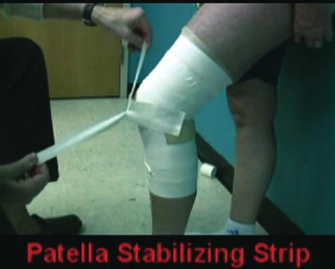 Once the strip has been applied laterally, the remaining tail is split, forming a Y-shaped piece of tape (Figure 51). Figure 53: The first additional lateral patellar anchoring strip.