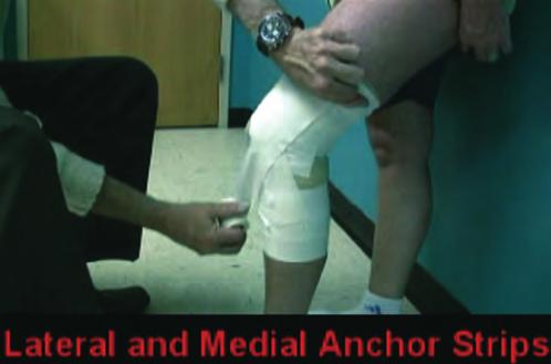 tails of the Y-shaped horizontal patellar stabilizing tape strip are anchored in place by placing the X-anchoring strips medially.