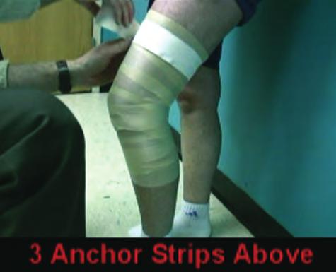 Figure 26: Initial crossing stability tape strip. Figure 24: Proximal anchoring strips of tape applied. Approximately 50% of the thigh is taped with anchoring strips.
