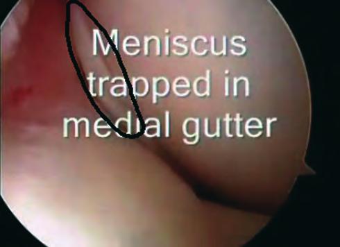 If the meniscus is damaged, this will cause pain; but if the meniscus is normal, this will not cause pain.
