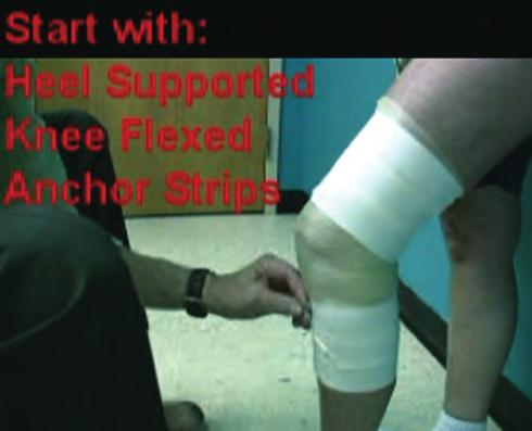 Figure 49: Second X-tape strip applied centered at the lateral patella border.