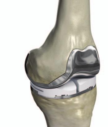 femur 3 1 2 patella tibia Left Knee: Osteoarthritis can affect one, two or all three compartments of the knee. Understanding your knee.