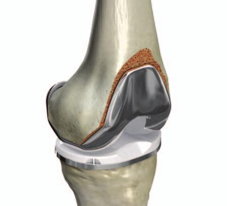 Total Knee Replacement Total knee replacement (TKR), also referred to as total knee arthroplasty (TKA), is a surgical procedure where worn, diseased, or damaged surfaces of a knee are
