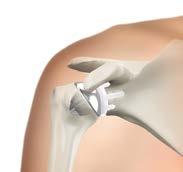 Shoulder Replacement Options The two most common shoulder replacement procedures performed are, primary total shoulder replacement and reversed total shoulder replacement.
