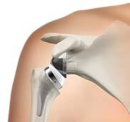Primary Total Shoulder A primary total shoulder replacement procedure may be performed using a stemless implant.