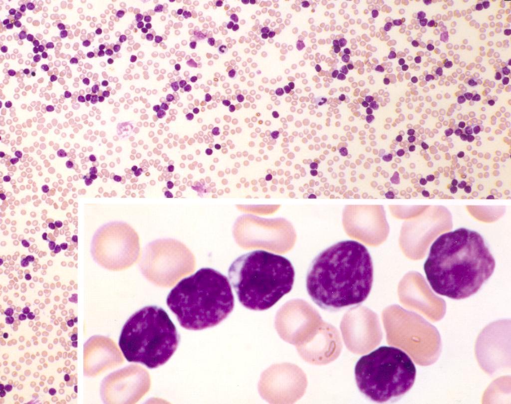 DIAGNOSIS OF CLL: 1:MORPHOLOGY BLOOD SMEAR CLL cell