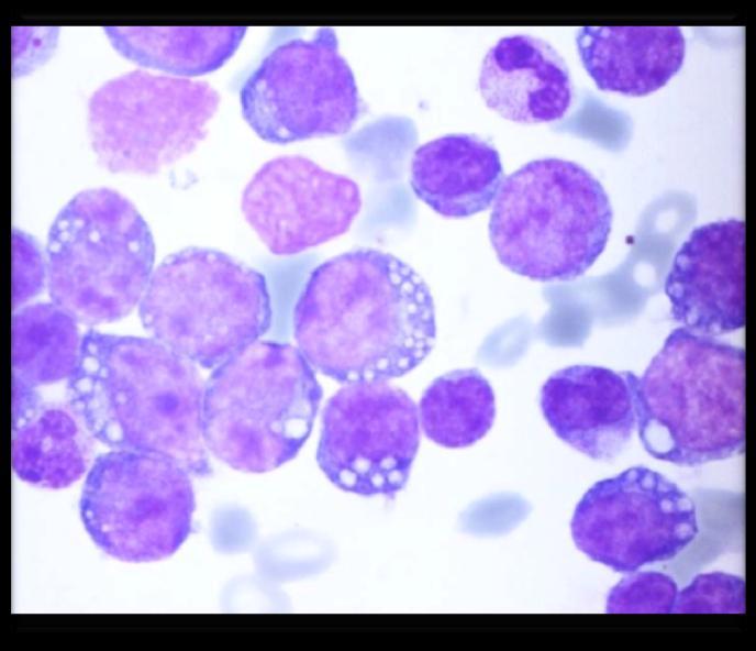 Richter s syndrome Prolymphocytic transformation (PLL) Transformation to DLBCL (95%) or Hodgkin s lymphoma (5%)