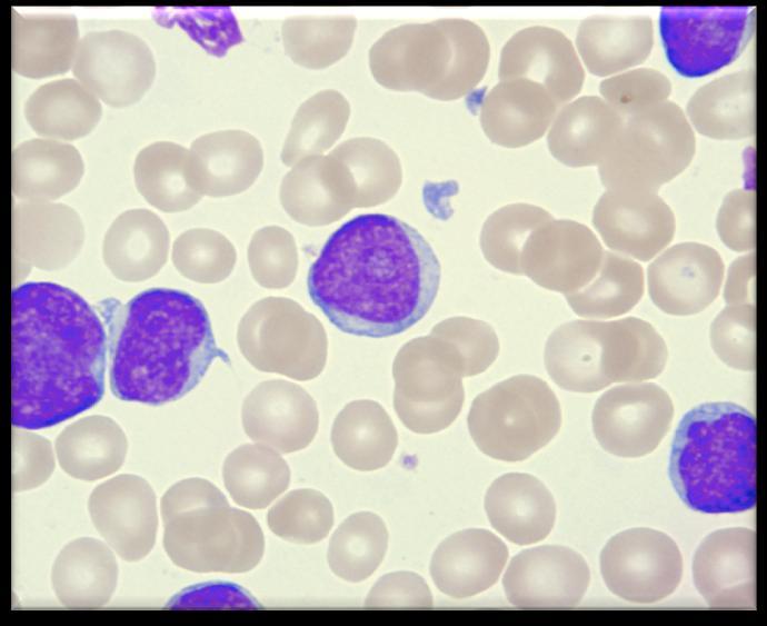 involvement, increasing LDH, and sometimes a monoclonal gammapathy Progressive increase of prolymphocytes in blood and