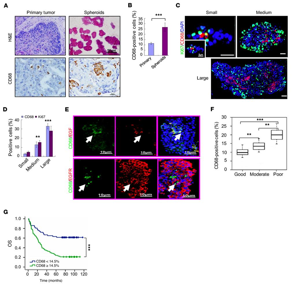 The Journal of Clinical Investigation Figure 5. Clinical relevance of spheroid formation between EGF + TAMs and EGFR + tumor cells in OC patients. (A and B) Macrophages and spheroids in human OC.