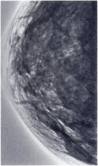 Localized lesions were charactenized by a focal distribution occurring in one segment of one breast.