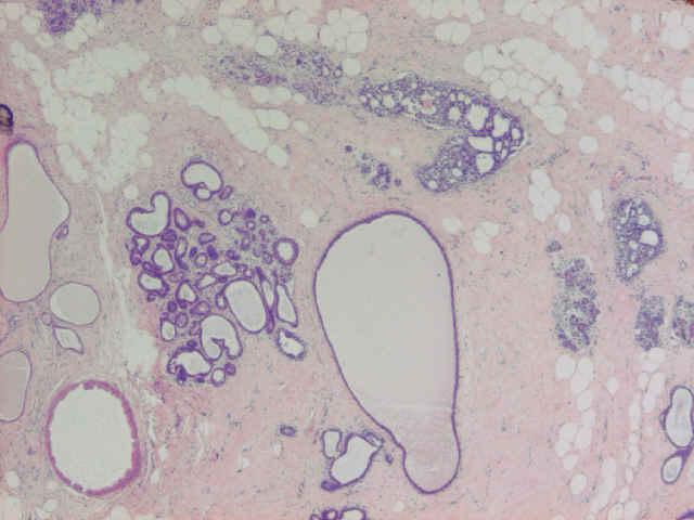 Flat Epithelial Atypia By low power, TDLUs are