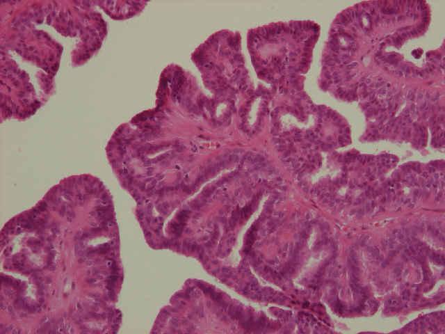 Benign Intraduct Papilloma Fronds covered by 2 layers of cells: