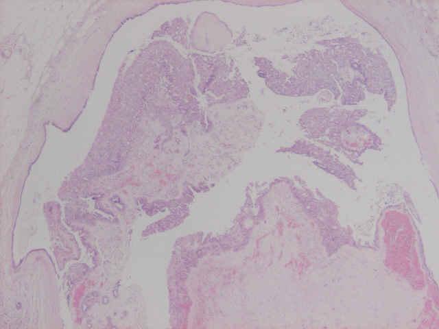 3. Intraduct papilloma with focal usual type hyperplasia The fronds are covered by more