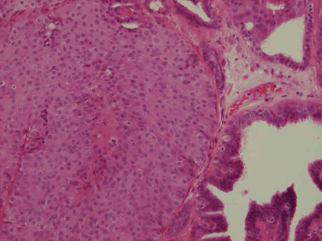 4. Intraduct papilloma with focal atypical hyperplasia atypical cells occupy an area less than 3mm Atypical