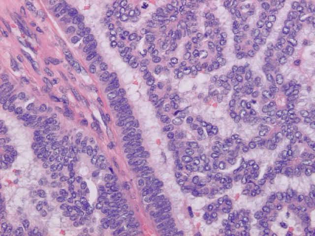 7. Intracystic (encapsulated) papillary carcinoma well-defined lesions consisting entirely of malignant cells covering papillary fronds,