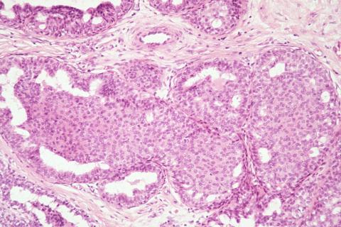 Florid Regular Hyperplasia The proliferating cells are similar to the normal cells lining the ducts The cells are haphazardly arranged, may
