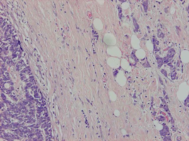 Intracystic (encapsulated) papillary carcinoma The lesion may be associated with foci of DCIS or frankly invasive carcinoma