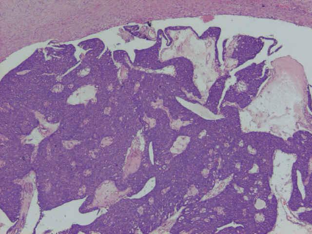 8. Solid Papillary carcinoma Circumscribed solid nodule May be