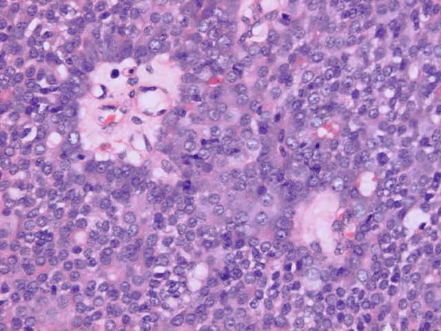 Solid Papillary carcinoma Discrete papillae are not present, but the underlying papillary
