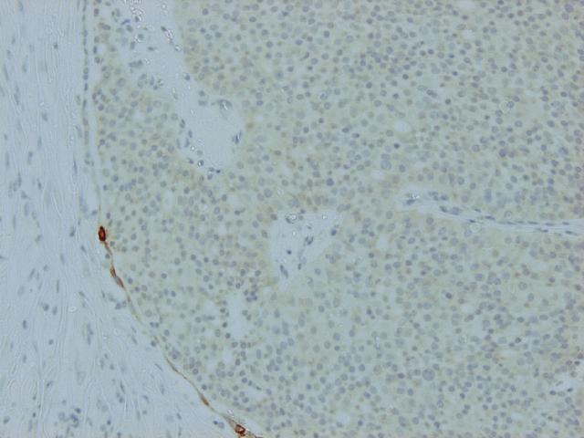 Solid Papillary carcinoma There are no myoepithelial cells within the lesion And myoepithelial cells may be also lacking around the lesion in some