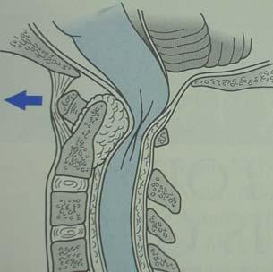 RHEUMATOID SPINE Involvement of the spine is common in rheumatoid.