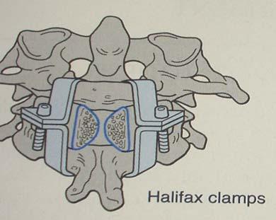 Halifax clamps Interlaminar clamp Pseudarthrosis: 20% Not commonly used Brooks Technique Patient prone and tongs traction [traction not required] Verify the position of atlas and axis under image