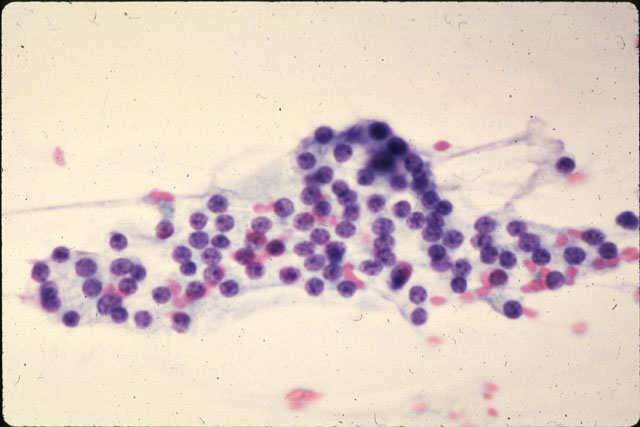 with thyroid nodule FNA result follicular lesion now what s the likelihood of Ca?