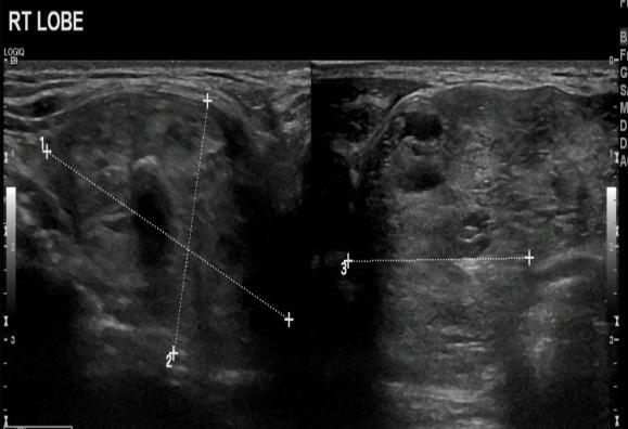 cultures. CT brain were normal, thyroid ultrasound showed multinodular goiter, see figures 2 and 3.