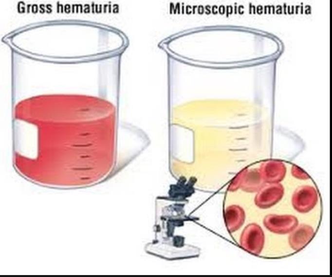 HAEMATURIA: MICRO: On microscopic analysis of urine