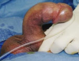PEYRONIE S DISEASE Recognise: Scar in the Tunica causing a bend in penis Up