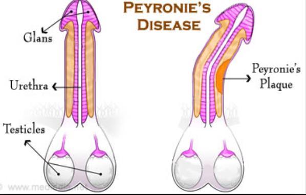 PEYRONIE S DISEASE Management: No oral