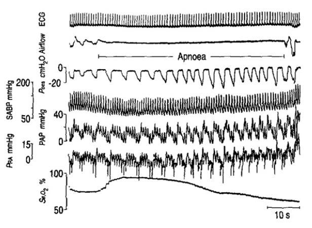 Hemodynamic changes in Obstructive Sleep Apnea Increases in systemic arterial blood pressure (SABP) Increases in