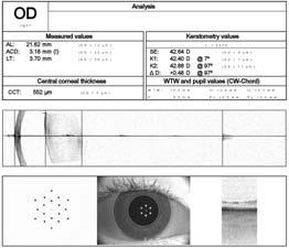 (this changes the patient s refraction) 4 Pachymetry Posterior and Anterior segment OCT Posterior OCT Posterior segment scans