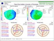 Color Vision Testing Corneal Topography D15 100 Hue COTs are used to