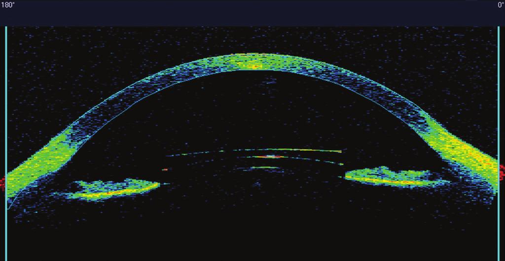 Sponsored by 43 Figure 7 OCT image of the anterior segment of an eye implanted with a phakic IOL Figure 8 OCT image of a cornea after LASIK surgery, revealing the thickness of the epithelium and