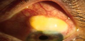 IOP too high or too low Conjunctival redness, irritation Conjunctival scarring (closes off the