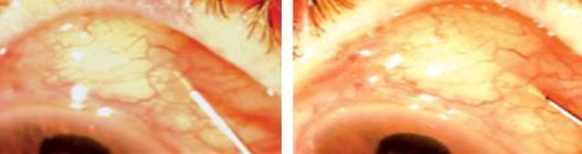 Choroidal detachments Hypotony maculopathy Cataracts CME Iris abnormalities Retinal tear or detachment