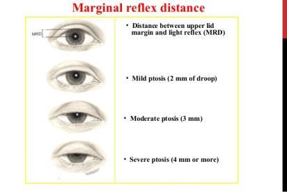 eyelid or their nerve supply Multiple causes including