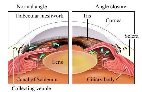 Tension Glaucoma (NTG) Narrow/Closed Angle Glaucoma (ACG)