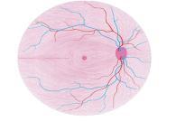 Increased IOP (ocular hypertension) Can cause ON damage One sign of