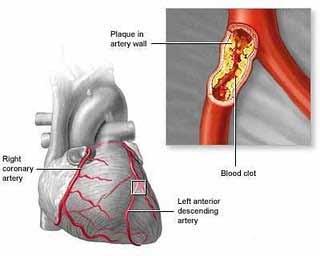 Atherosclerosis Leads to narrowing or blockage of arteries Blocked flow to the heart Myocardial infarction (heart attack)