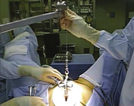 Figure 3: Gasless laparoendoscopic single-site myomectomy was performed through an Alexis wound retractor (small size, Applied Medical, Rancho Santa Margarita, CA) attached via a 2.