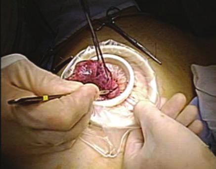 Case Reports in Obstetrics and Gynecology 3 Figure 5: Extracorporeal extraction of excised myoma was performed through the umbilical incision by in-bag manual morcellation using a number 11 surgical