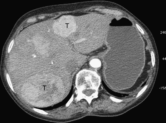 Surgery for Gastrinoma 1093 Fig. 2. Arterial phase CT scan demonstrating hypervascular liver metastases. a fasting serum gastrin level and ascertainment of the presence of gastric acid hypersecretion.