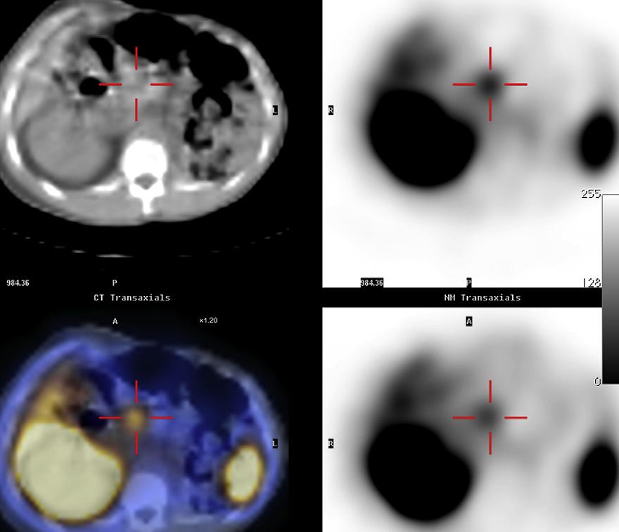 Surgery for Gastrinoma 1095 Table 3 Results of imaging studies for metastatic gastrinoma Imaging Modality Sensitivity SRS 92% CT 42% 56% MRI 71% 83% Arterial Angiography 61% 62% Data from Klose KJ,