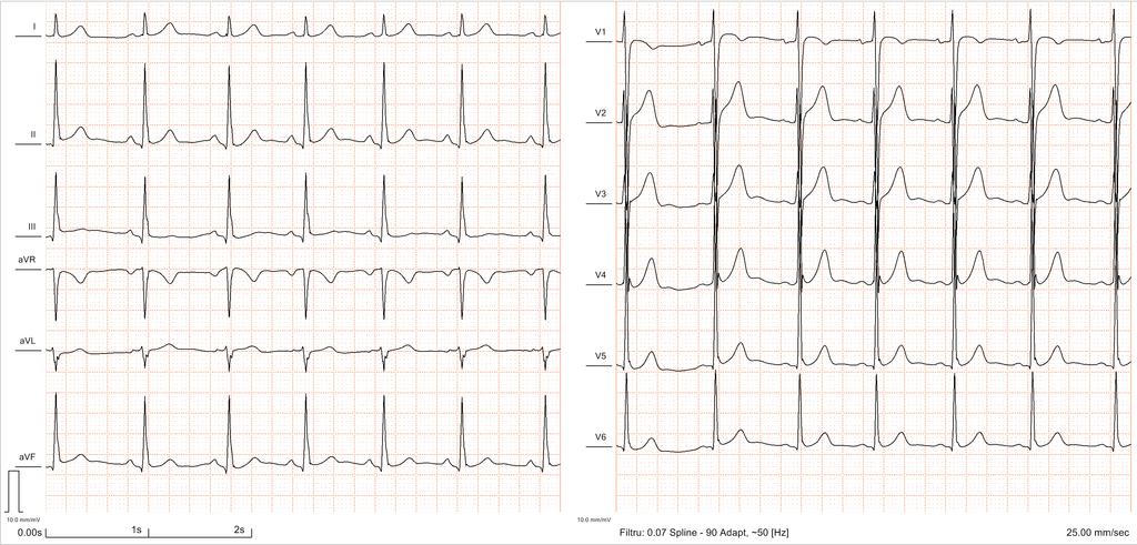 ECG registration with J-waves appearing as slur on the positive R-wave descending limb in infero-lateral (II, III, avf, V5,6) leads (from the personal collection of Dr. Szabó I.A.) Molecular basis.