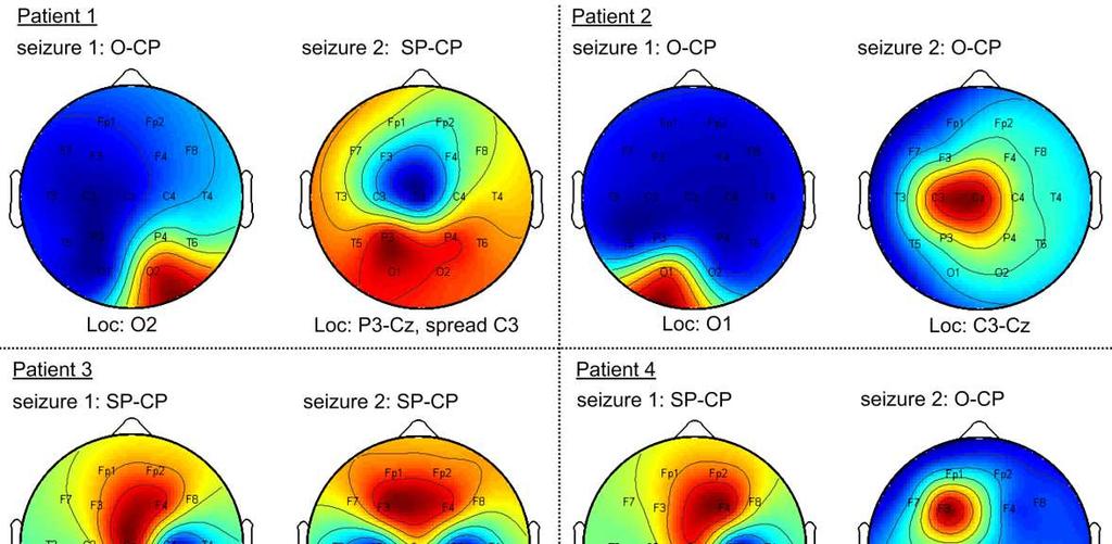 Validation study Comparison with visual analysis of the EEG by a neurophysiologist.