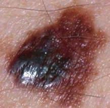 Malignant melanoma is the rarest form of skin cancer but is the most serious and can kill. Malignant melanoma is curable if treated early.